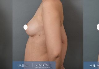 療程效果因人而異，上圖為C罩杯產後女性在做完自體脂肪隆乳之後​手術後一個月、手術後兩個月成效